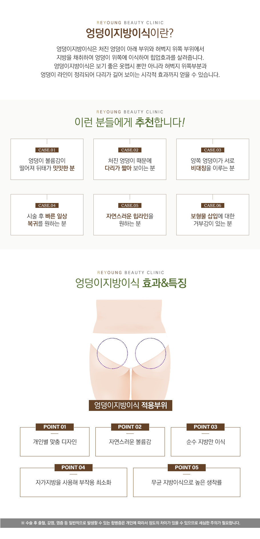 엉덩이지방이식