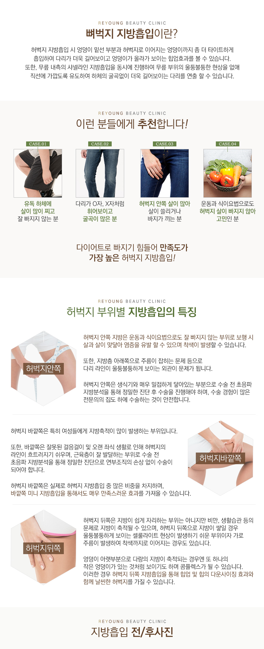 뼈벅지지방흡입